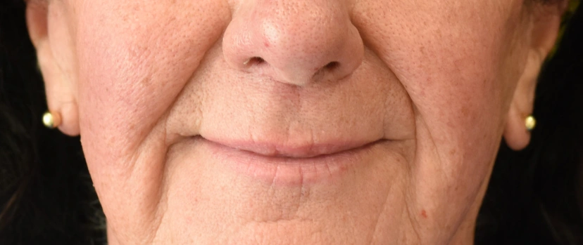 Lip Lift Patient 2 Set 2 After