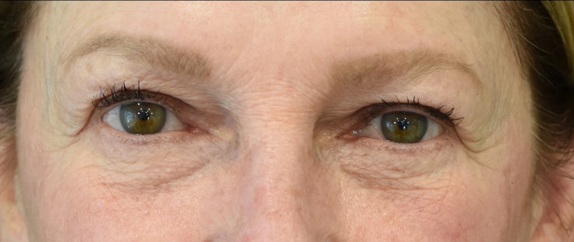 Eyelid Surgery Patient 11 Set 1 After