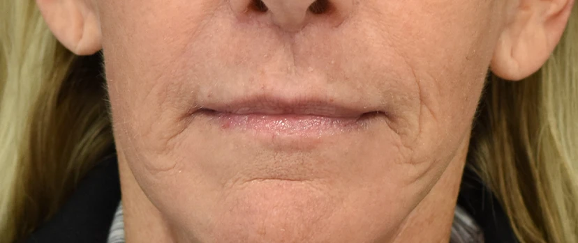 Lip Lift Patient 13 Set 1 After