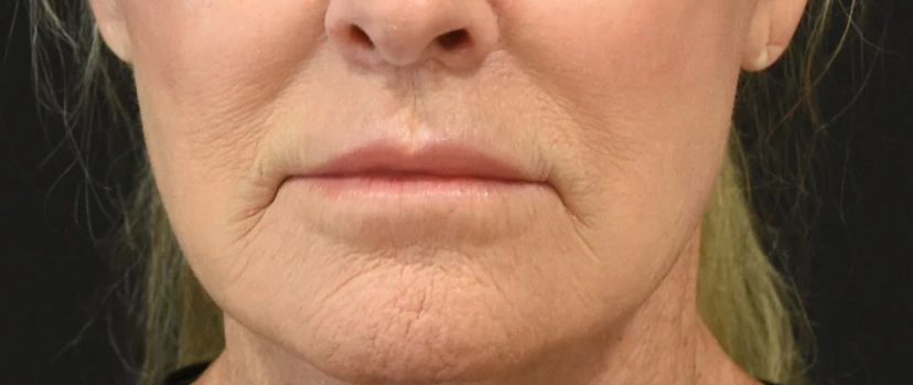 Lip Lift Patient 4 Set 1 After